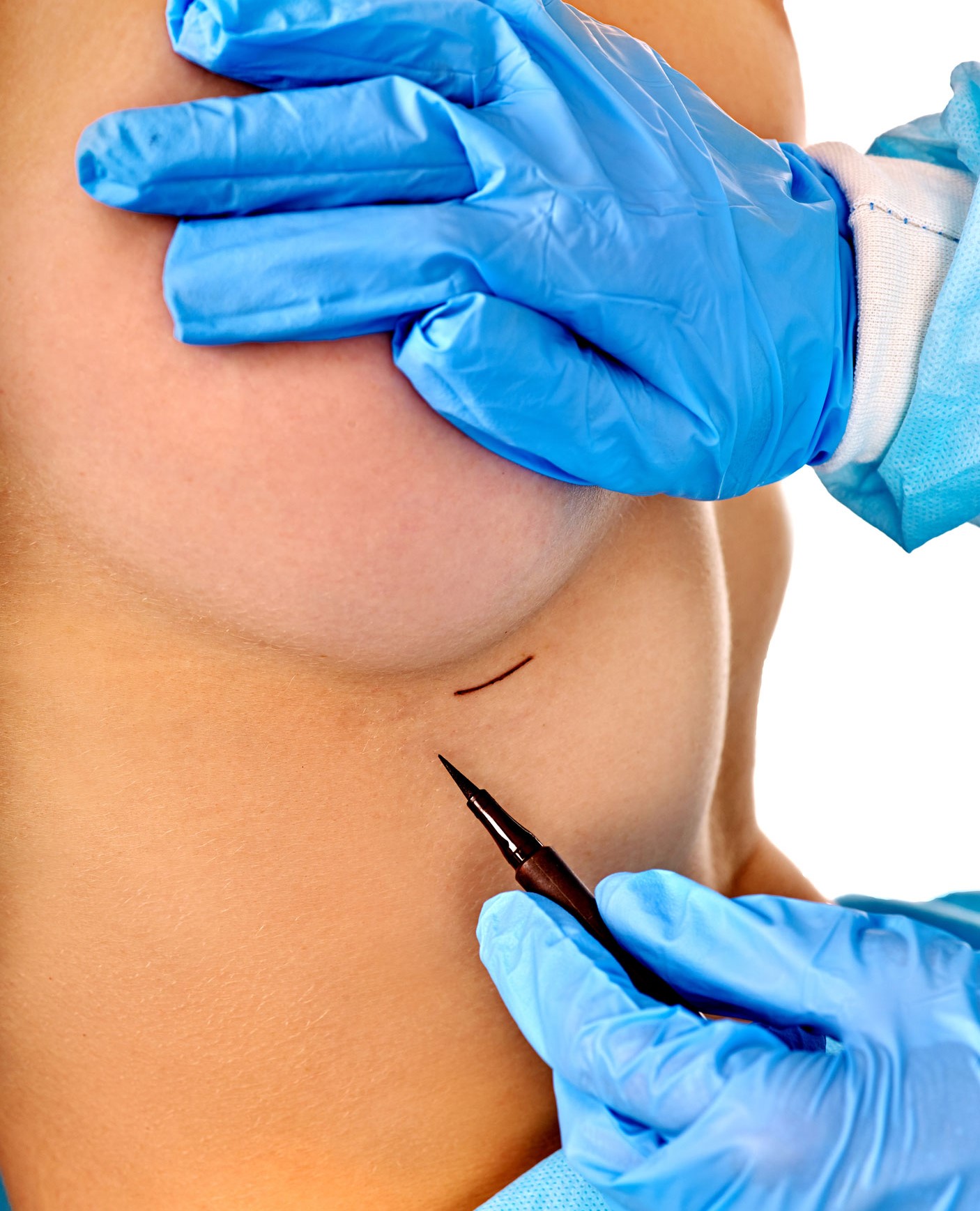 Evan Woo Breast Surgery Incision Site Evan Woo Breast Surgery Incision Site